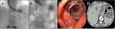 Endoscopic reversal of roux-en-Y gastric bypass prevents worsening of nutritional outcomes in patients with severe malnutrition